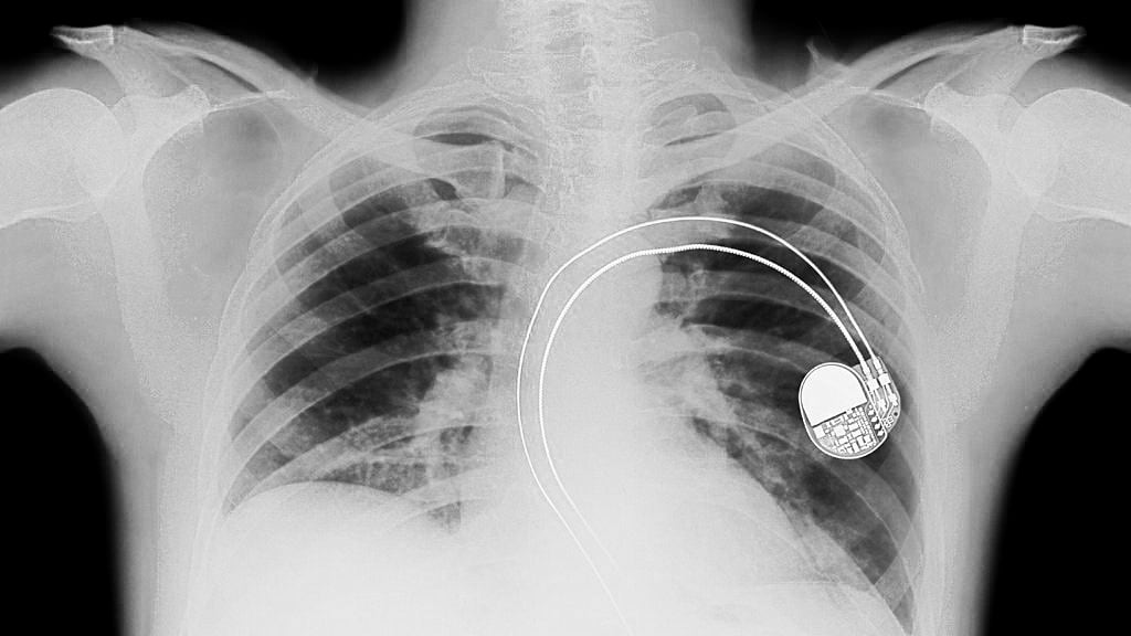 Baker's Gas X-Ray showing a pacemaker